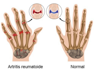 Científicos de la UCSM habrían descubierto cura para la artritis reumatoide