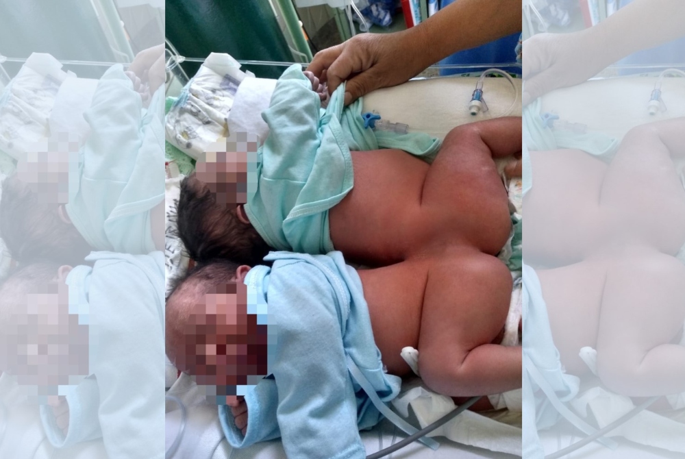 Arequipa: bebés siameses pueden ser  separados al no tener órganos unidos