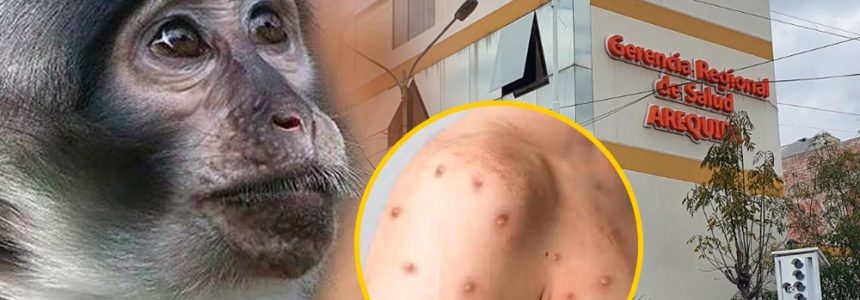 arequipa-viruela-del-mono-1