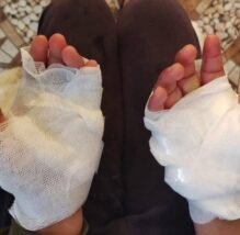 Arequipa Quemaduras Puno