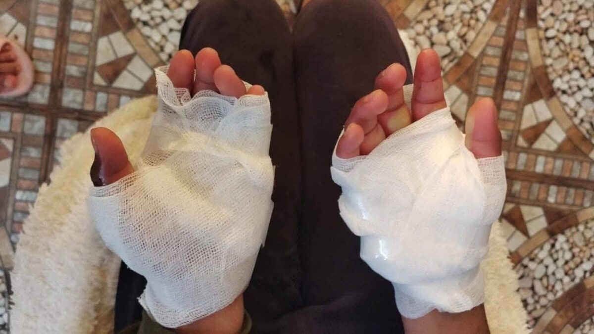 Menor de 11 años permanece internada en Arequipa con graves quemaduras por presunto castigo del padrastro en Puno